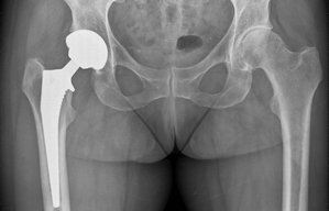 Yale Hüfte OP nachher Orthopäde. Orthopädie Unfallchirurgie in Gräfelfing  München