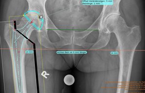Yale Hüfte OP Planung Orthopäde. Orthopädie Unfallchirurgie in Gräfelfing  München