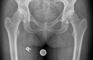 Yale Hüfte OP vorher Orthopäde. Orthopädie Unfallchirurgie in Gräfelfing  München